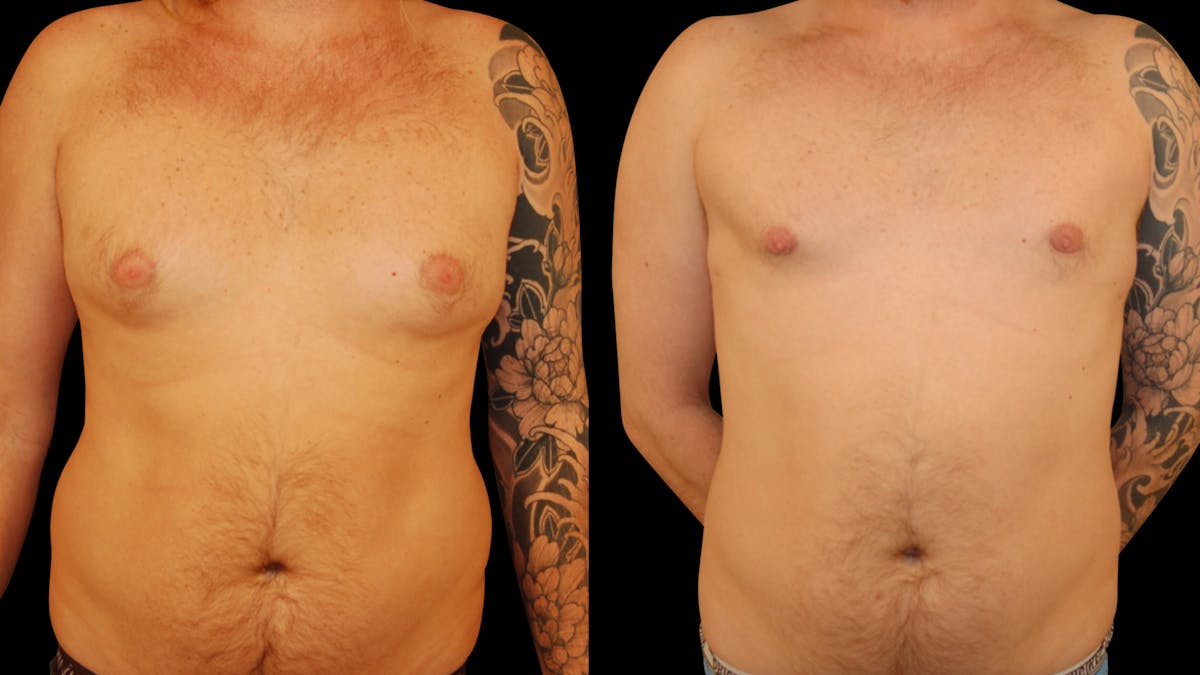 Gynecomastia Before & After Gallery - Patient 355753 - Image 1