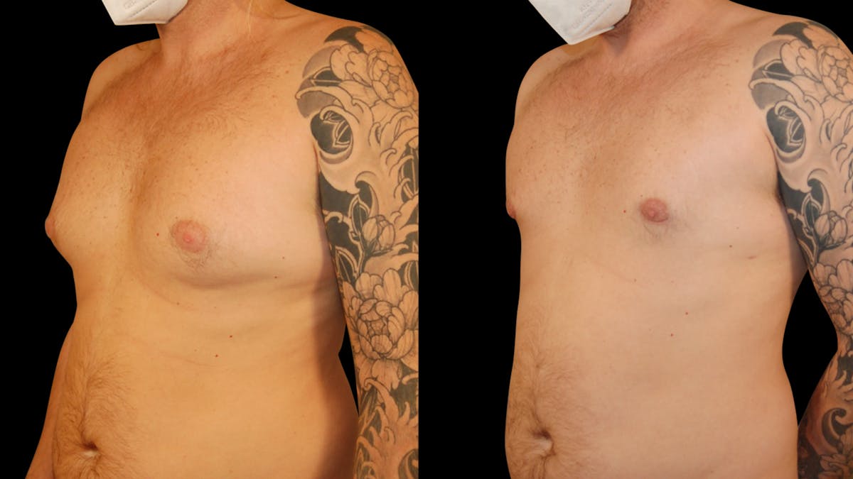 Gynecomastia Before & After Gallery - Patient 355753 - Image 2