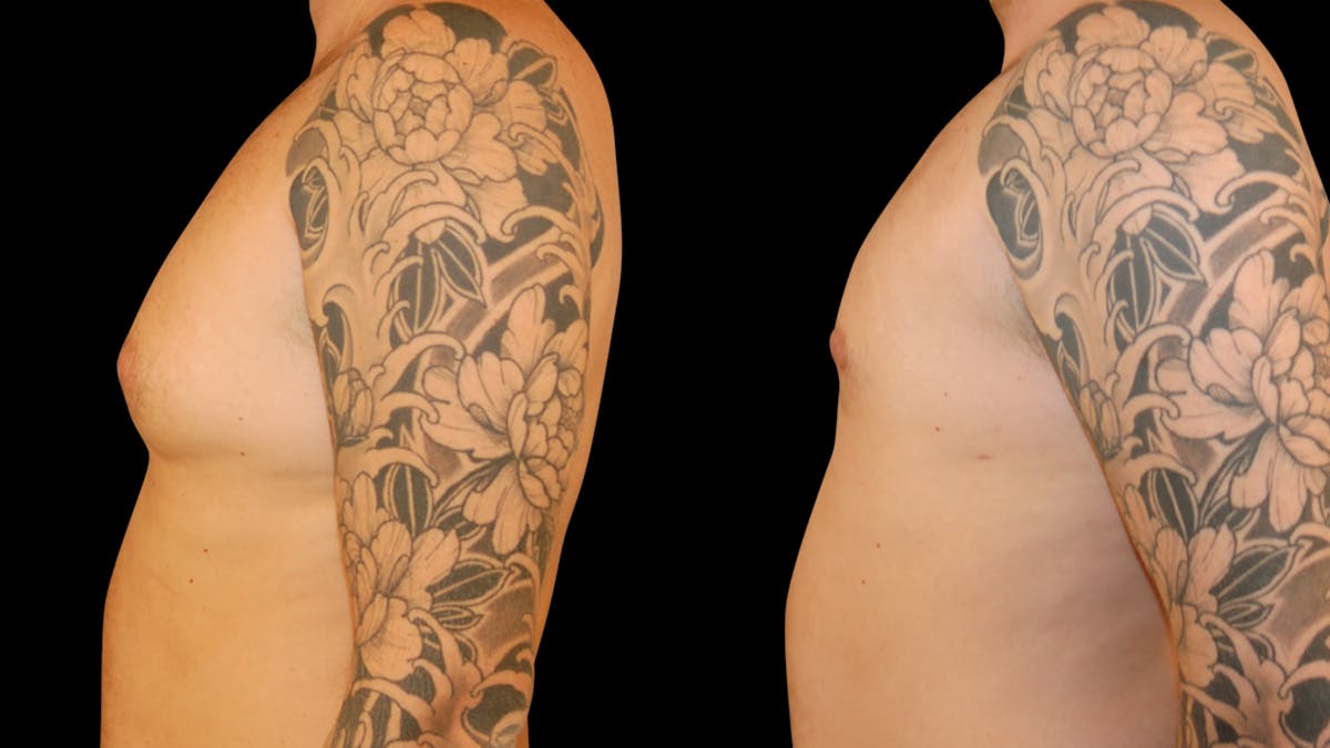 Gynecomastia Before & After Gallery - Patient 355753 - Image 3