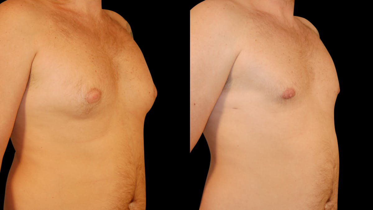 Gynecomastia Before & After Gallery - Patient 355753 - Image 4