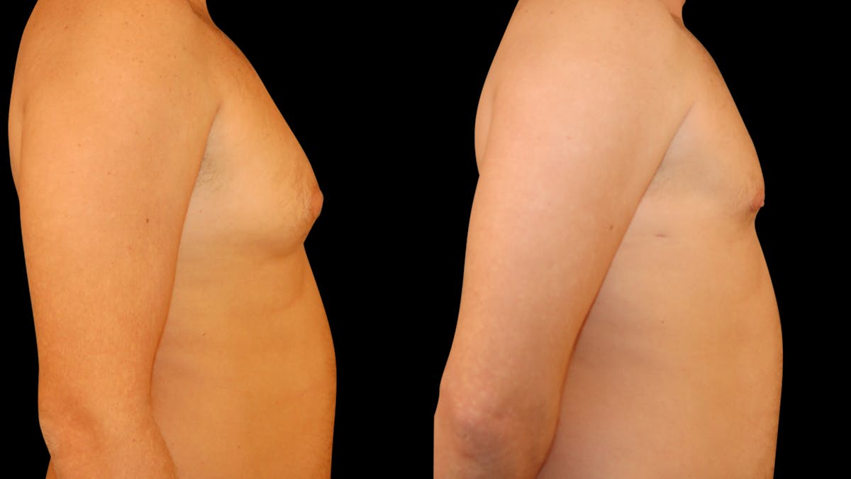Gynecomastia Before & After Gallery - Patient 355753 - Image 5