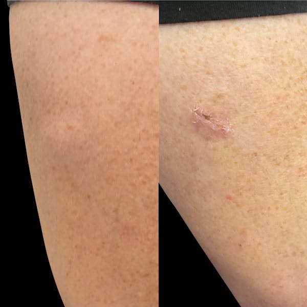 Lipoma Before & After Gallery - Patient 408451 - Image 1
