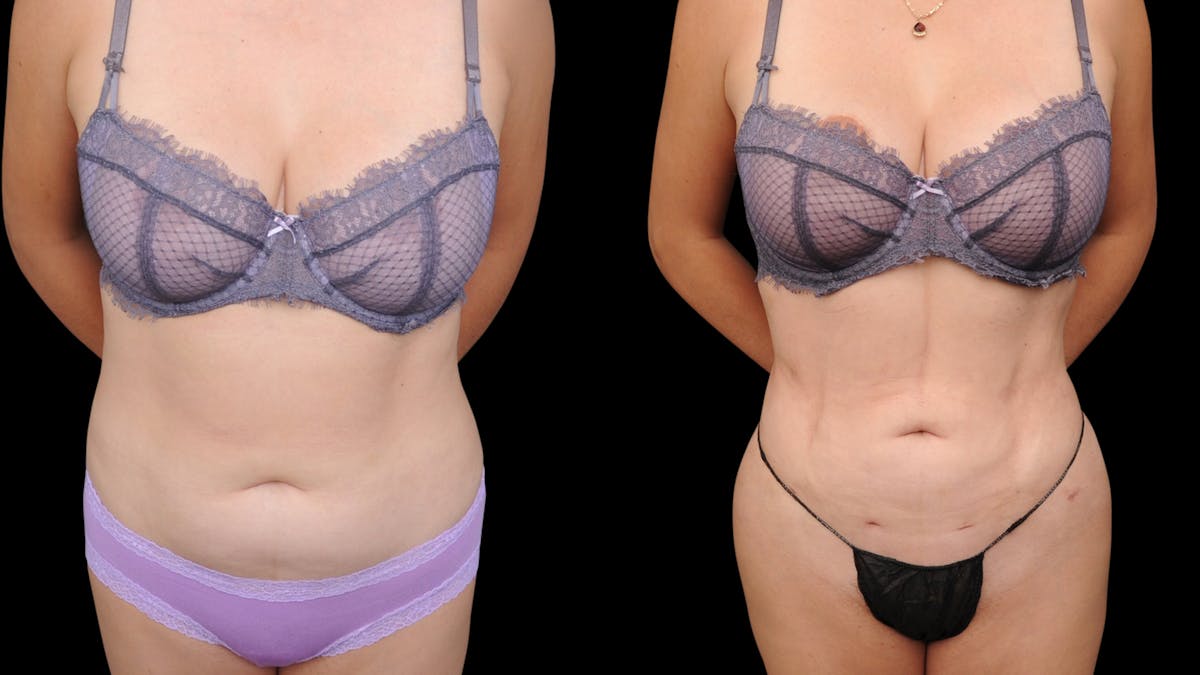 Liposuction Before & After Gallery - Patient 428281 - Image 1