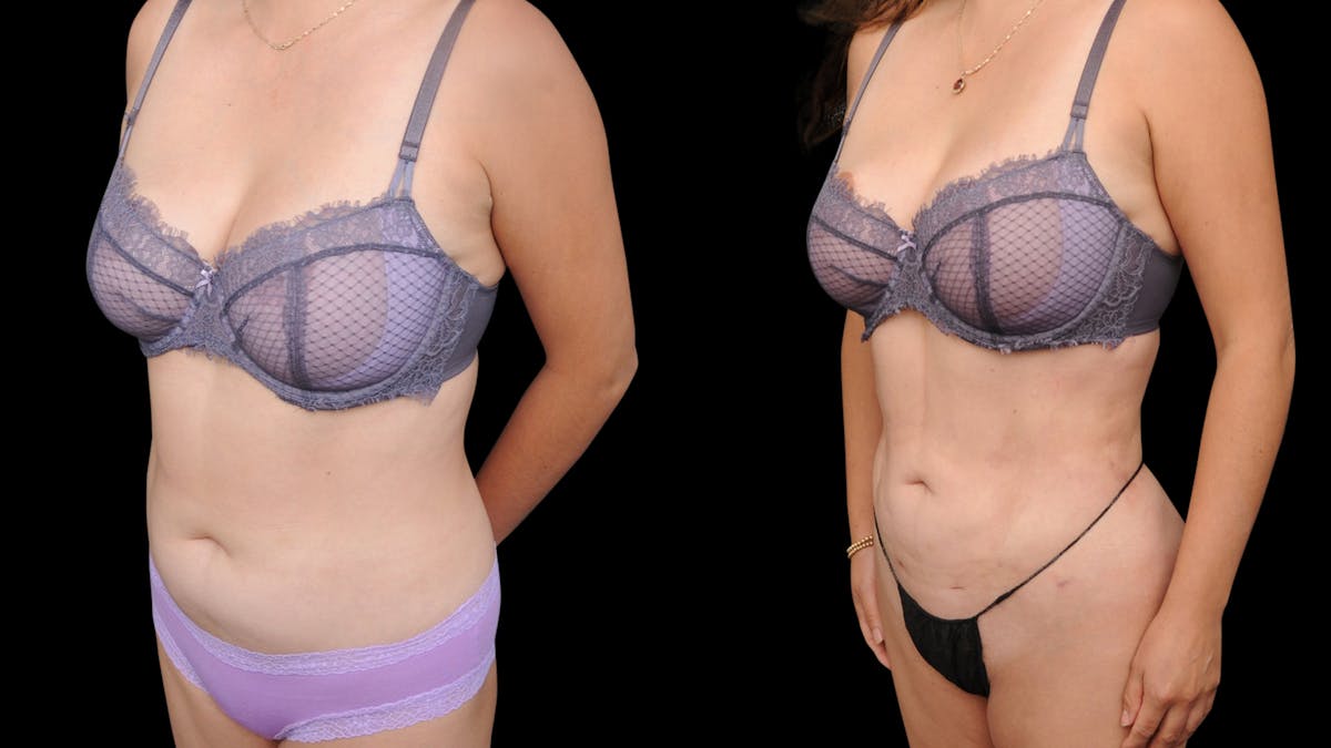 Liposuction Before & After Gallery - Patient 428281 - Image 2