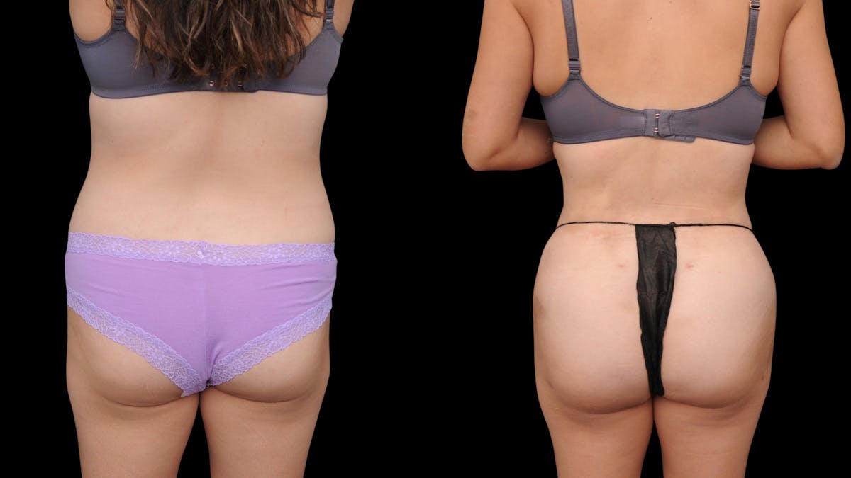 Liposuction Before & After Gallery - Patient 428281 - Image 4