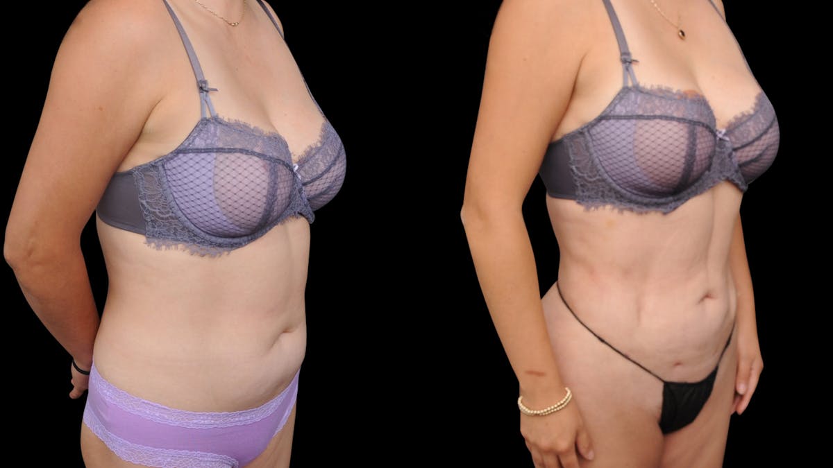 Liposuction Before & After Gallery - Patient 428281 - Image 5