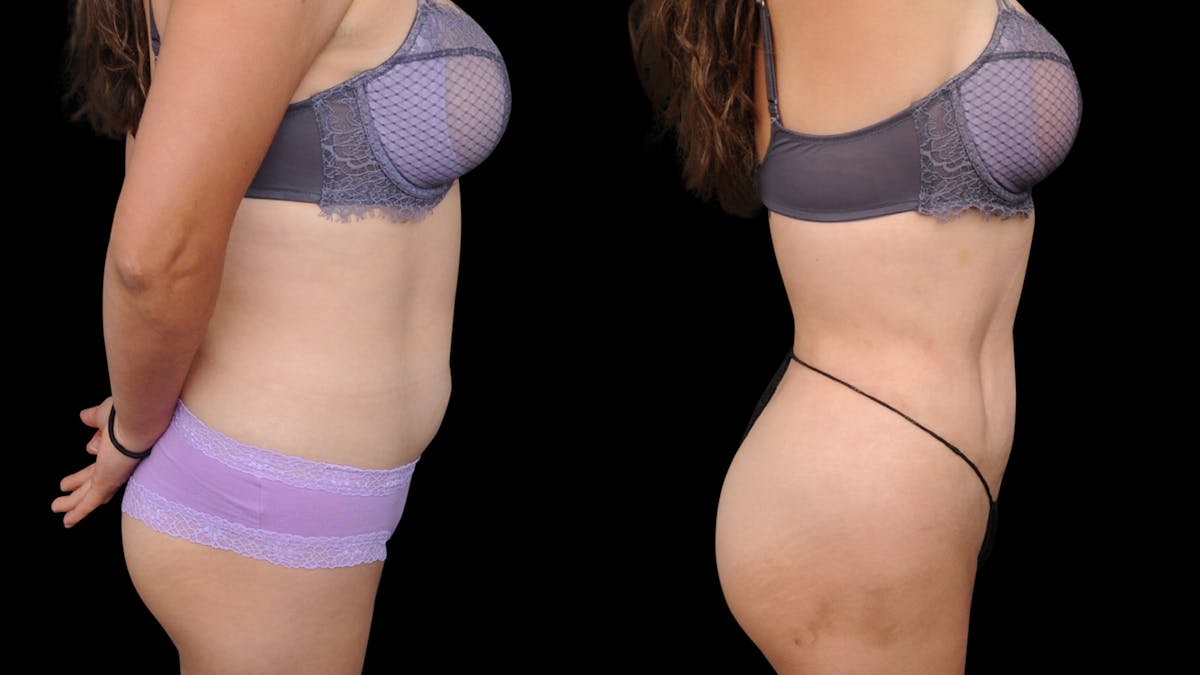 Liposuction Before & After Gallery - Patient 428281 - Image 6