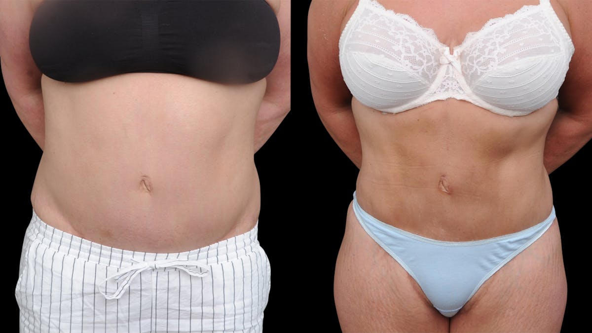 Liposuction Before & After Gallery - Patient 208462 - Image 1