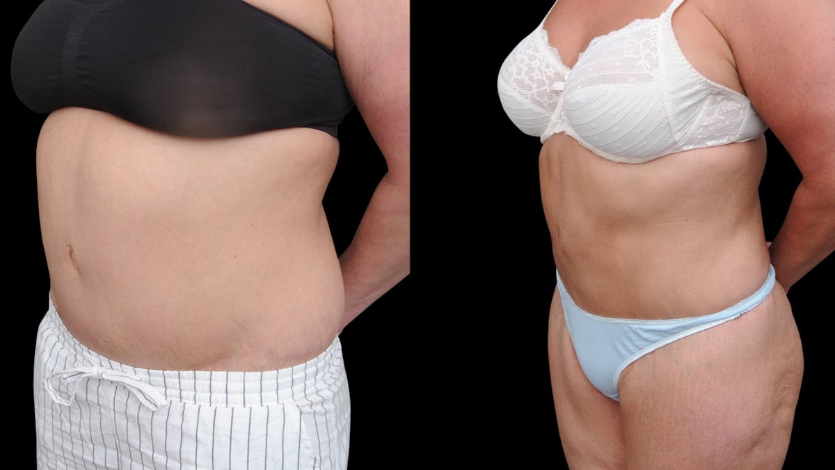 Liposuction Before & After Gallery - Patient 208462 - Image 2