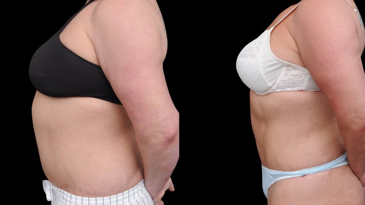 Liposuction Before & After Gallery - Patient 208462 - Image 3