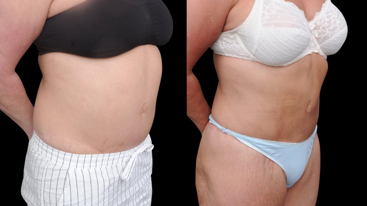 Liposuction Before & After Gallery - Patient 208462 - Image 4