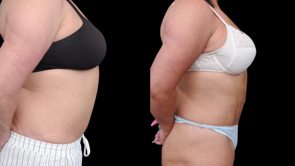 Liposuction Before & After Gallery - Patient 208462 - Image 5