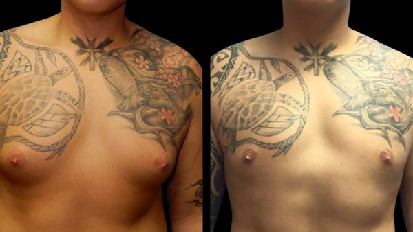 Liposuction Before & After Gallery - Patient 224108 - Image 1