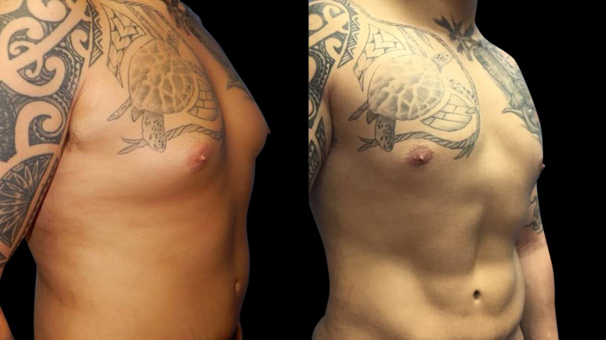 Liposuction Before & After Gallery - Patient 224108 - Image 2