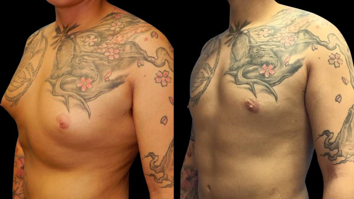 Liposuction Before & After Gallery - Patient 224108 - Image 3
