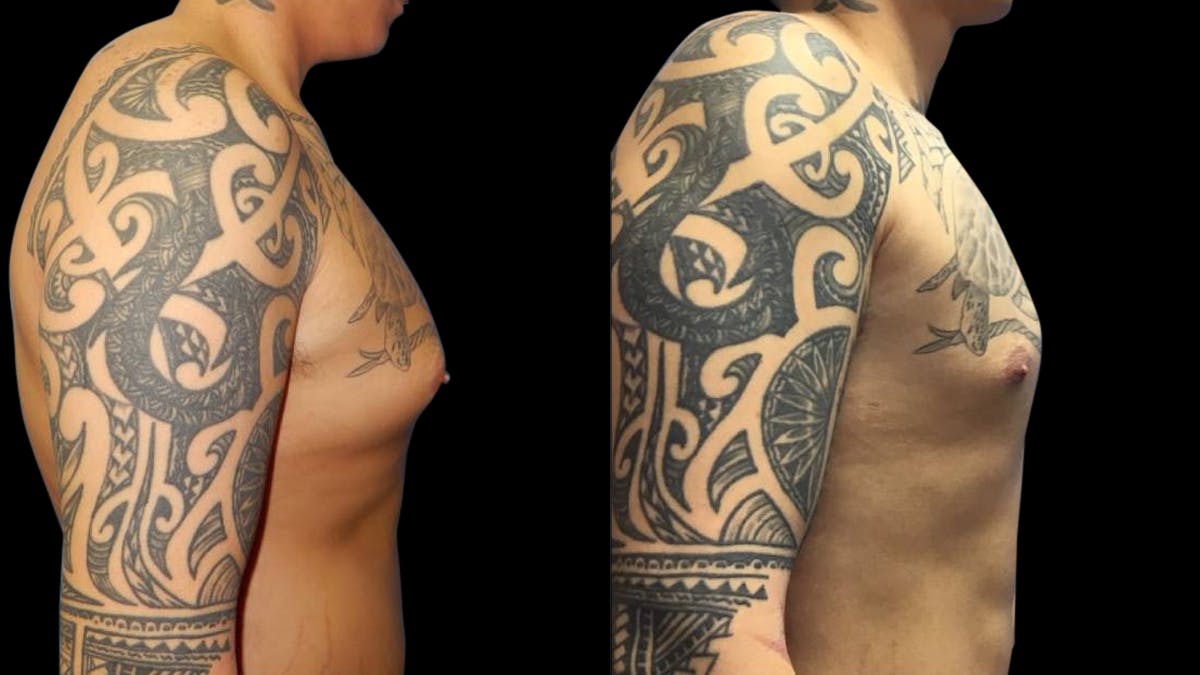Liposuction Before & After Gallery - Patient 224108 - Image 4