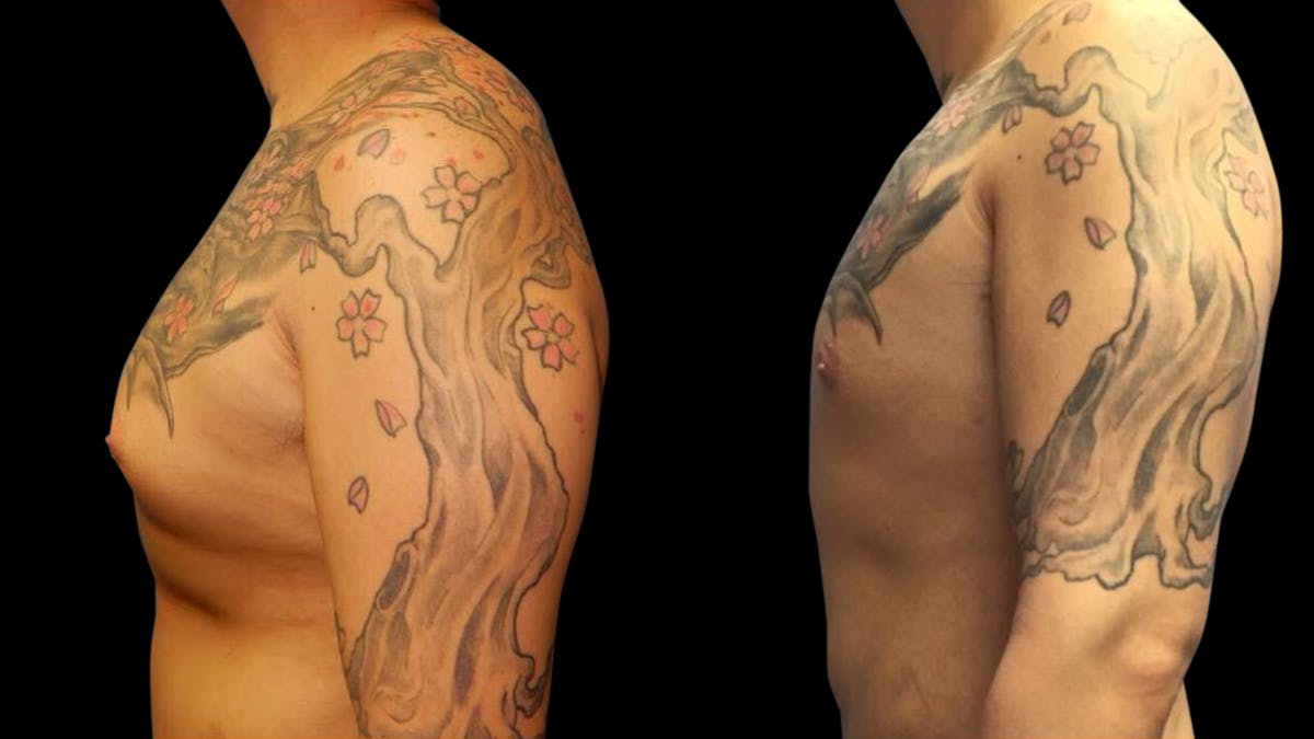 Liposuction Before & After Gallery - Patient 224108 - Image 5