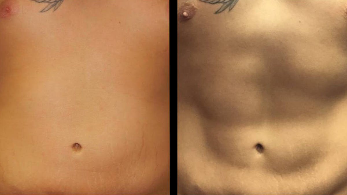 Liposuction Before & After Gallery - Patient 224108 - Image 6