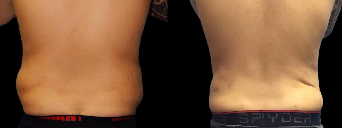 Liposuction Before & After Gallery - Patient 224108 - Image 7