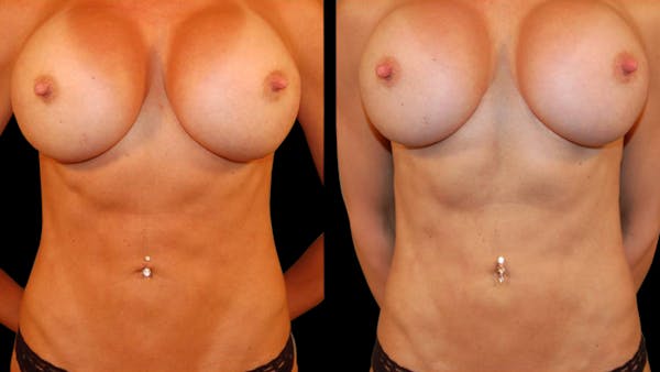 Liposuction Before & After Gallery - Patient 256257 - Image 1