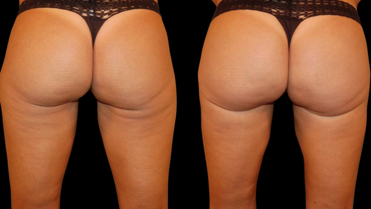 Liposuction Before & After Gallery - Patient 256257 - Image 2