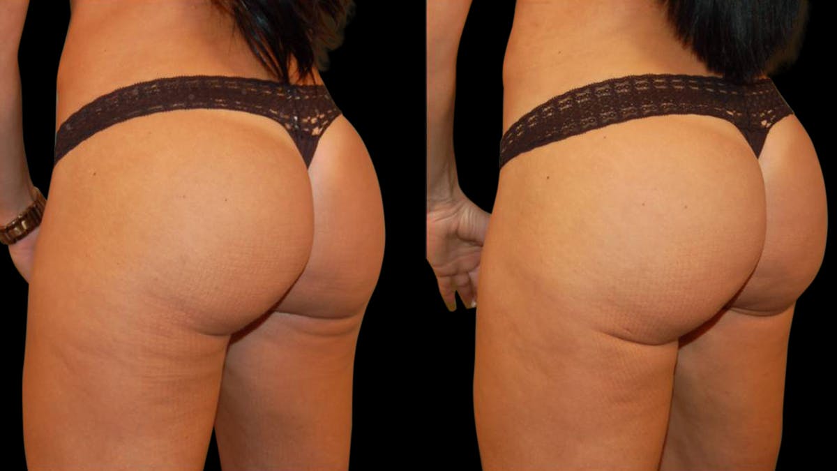 Liposuction Before & After Gallery - Patient 256257 - Image 3