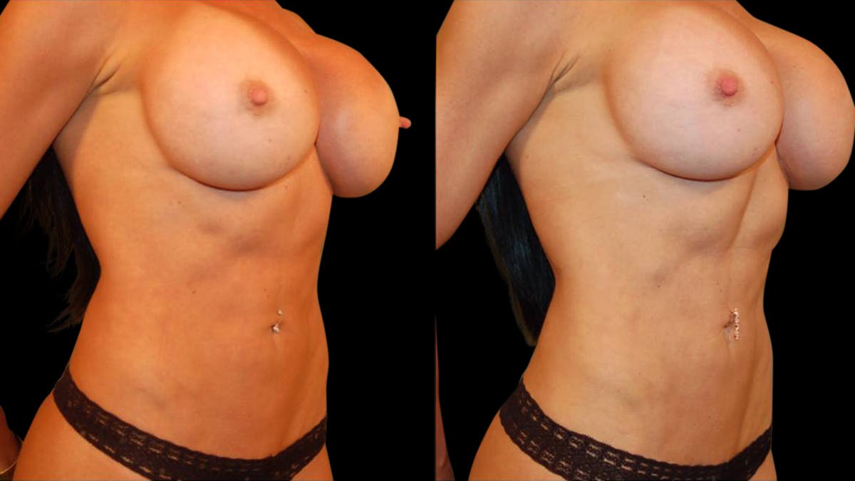 Liposuction Before & After Gallery - Patient 256257 - Image 6