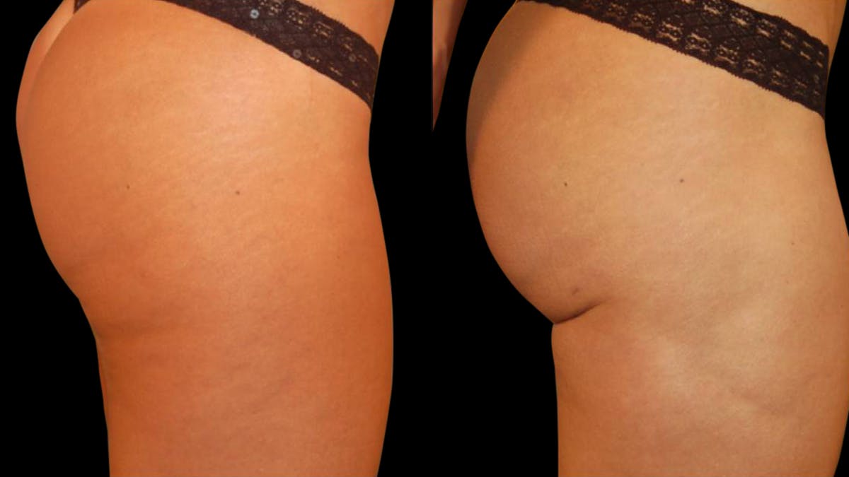 Liposuction Before & After Gallery - Patient 256257 - Image 7