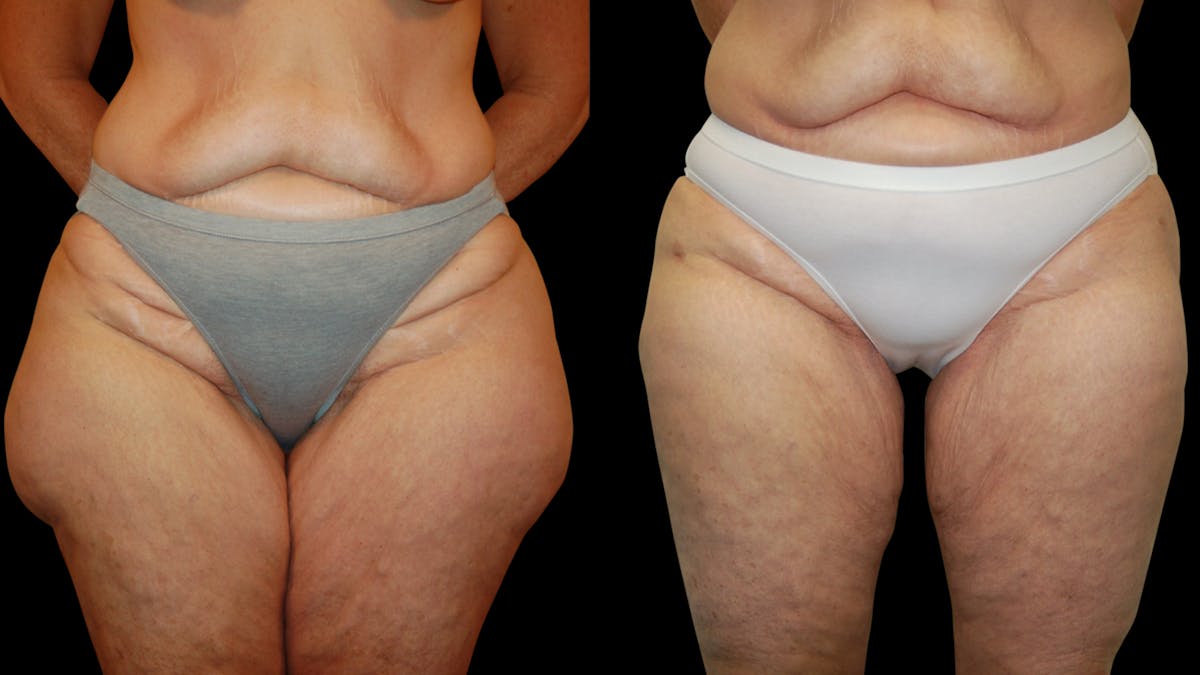 Liposuction Before & After Gallery - Patient 343447 - Image 1