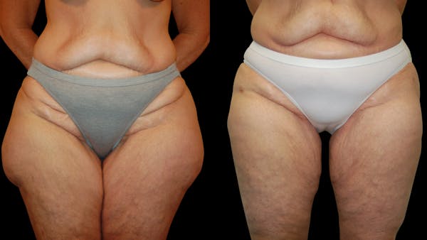 Liposuction Before & After Gallery - Patient 343447 - Image 1