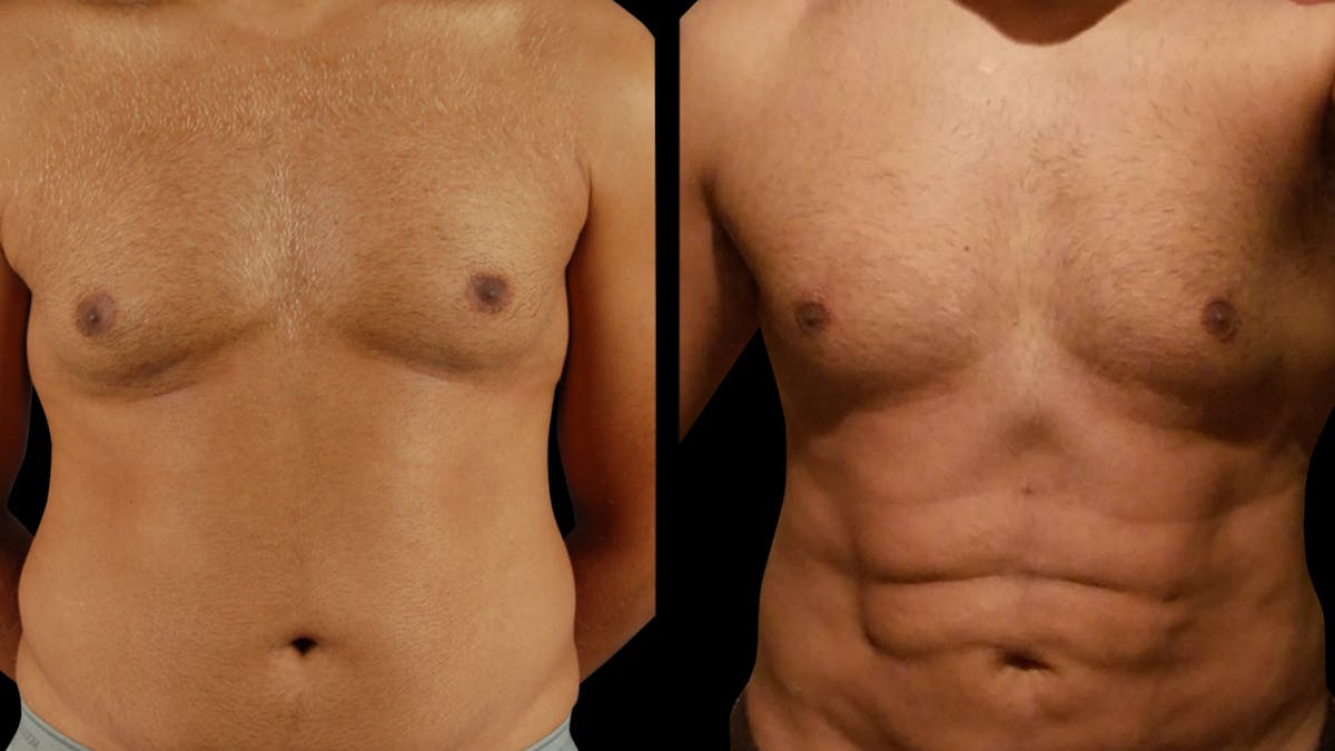 Liposuction Before & After Gallery - Patient 232600 - Image 1