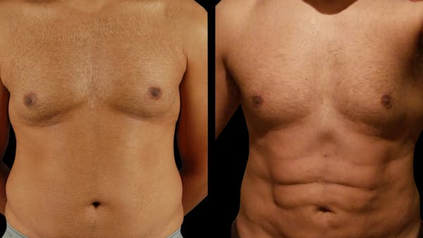 Liposuction Before & After Gallery - Patient 232600 - Image 1