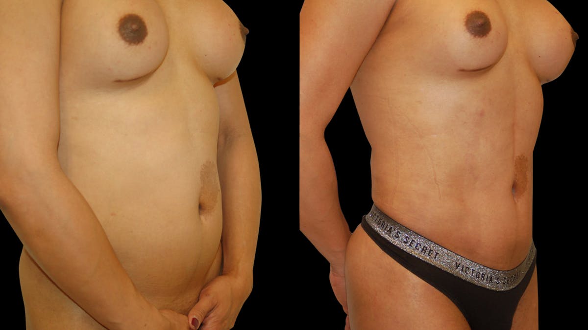 Liposuction Before & After Gallery - Patient 377538 - Image 1