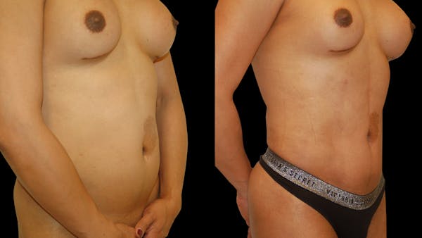 Liposuction Before & After Gallery - Patient 377538 - Image 1