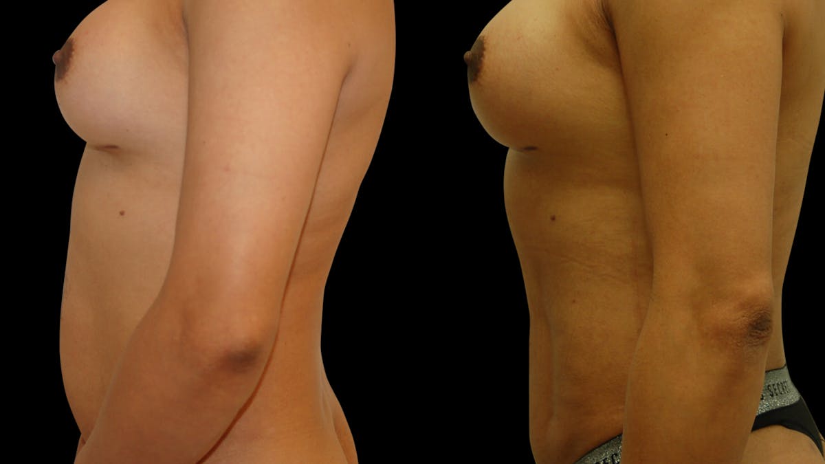 Liposuction Before & After Gallery - Patient 377538 - Image 3