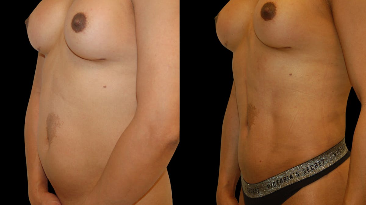 Liposuction Before & After Gallery - Patient 377538 - Image 4