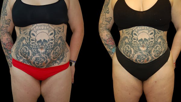 Liposuction Before & After Gallery - Patient 235574 - Image 1