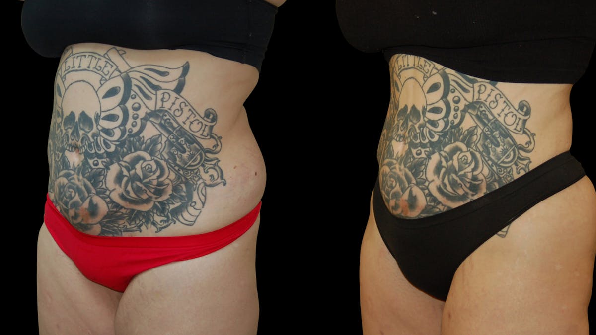 Liposuction Before & After Gallery - Patient 235574 - Image 2