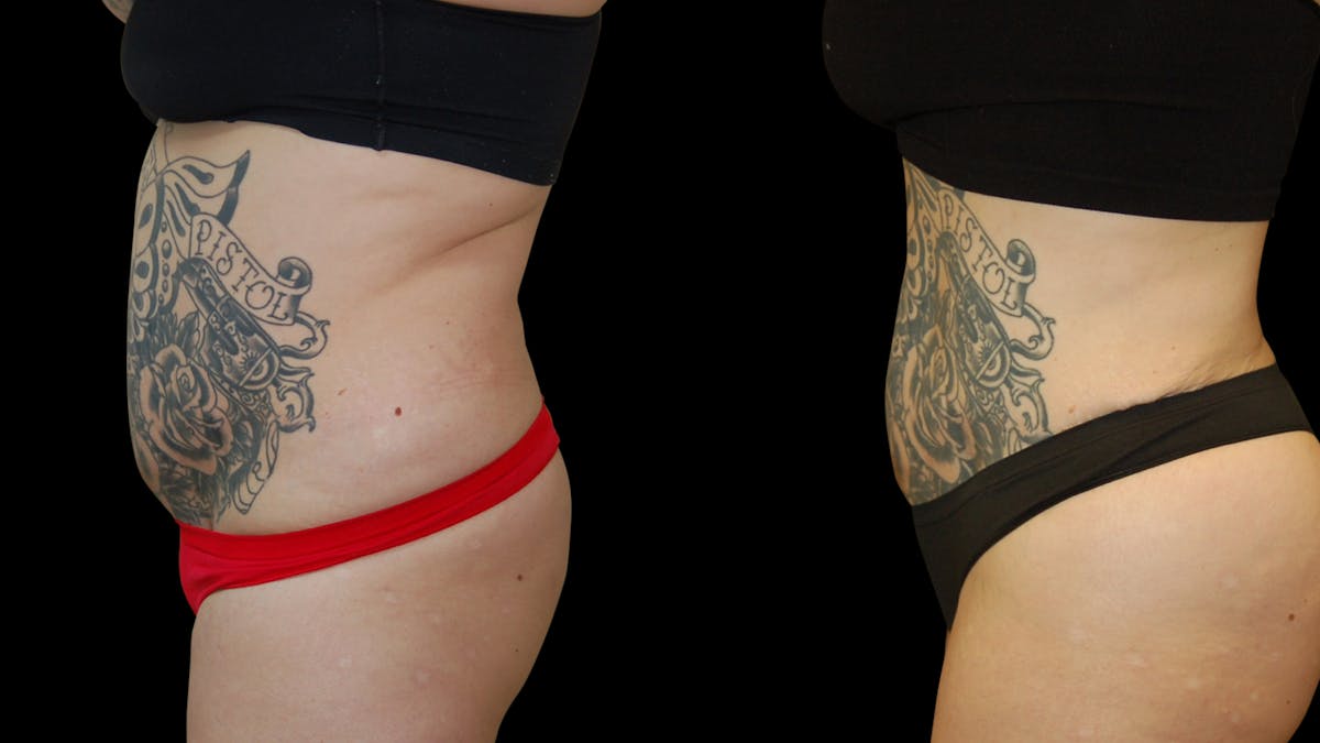 Liposuction Before & After Gallery - Patient 235574 - Image 3