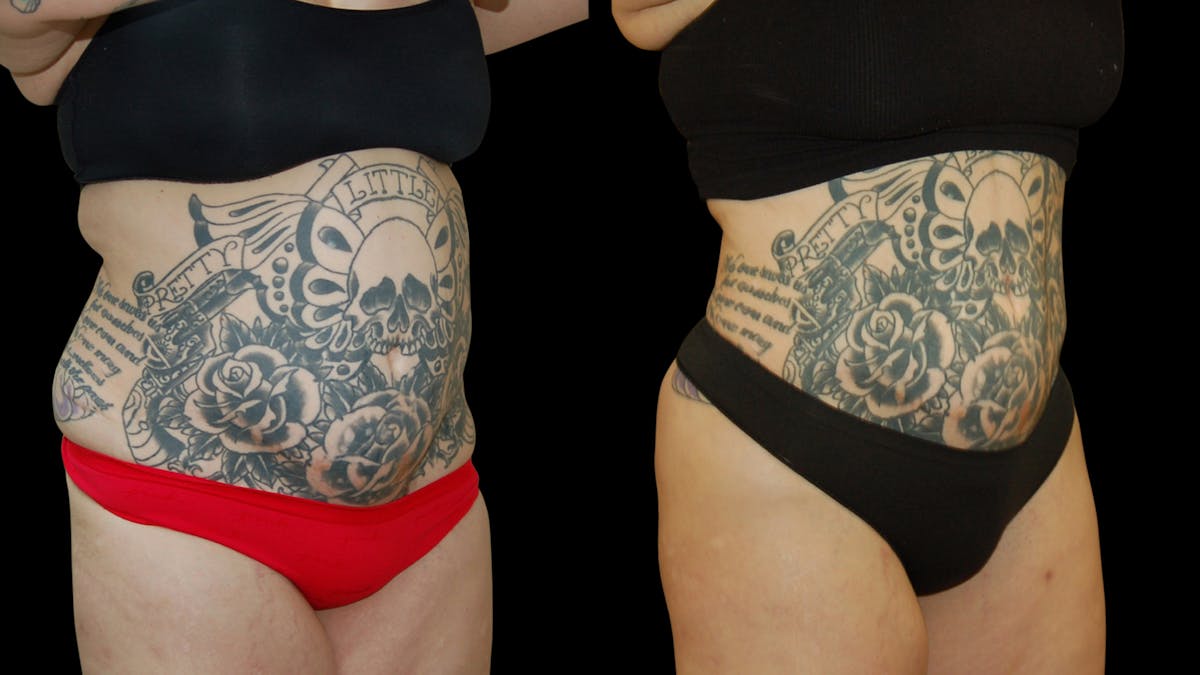 Liposuction Before & After Gallery - Patient 235574 - Image 4