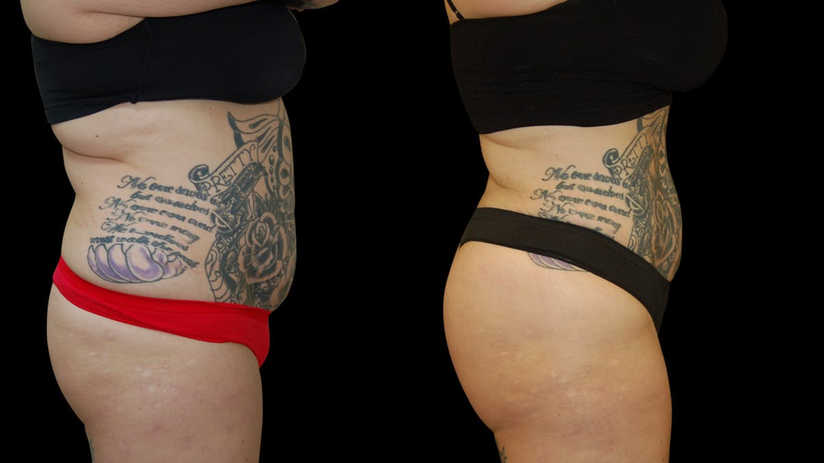 Liposuction Before & After Gallery - Patient 235574 - Image 5