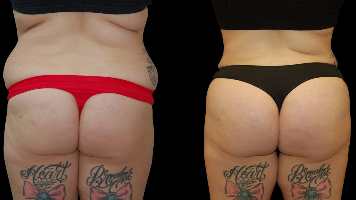 Liposuction Before & After Gallery - Patient 235574 - Image 6