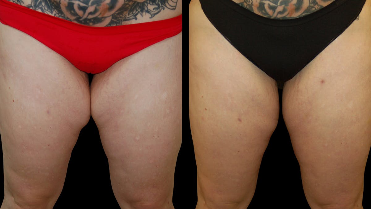 Liposuction Before & After Gallery - Patient 235574 - Image 7