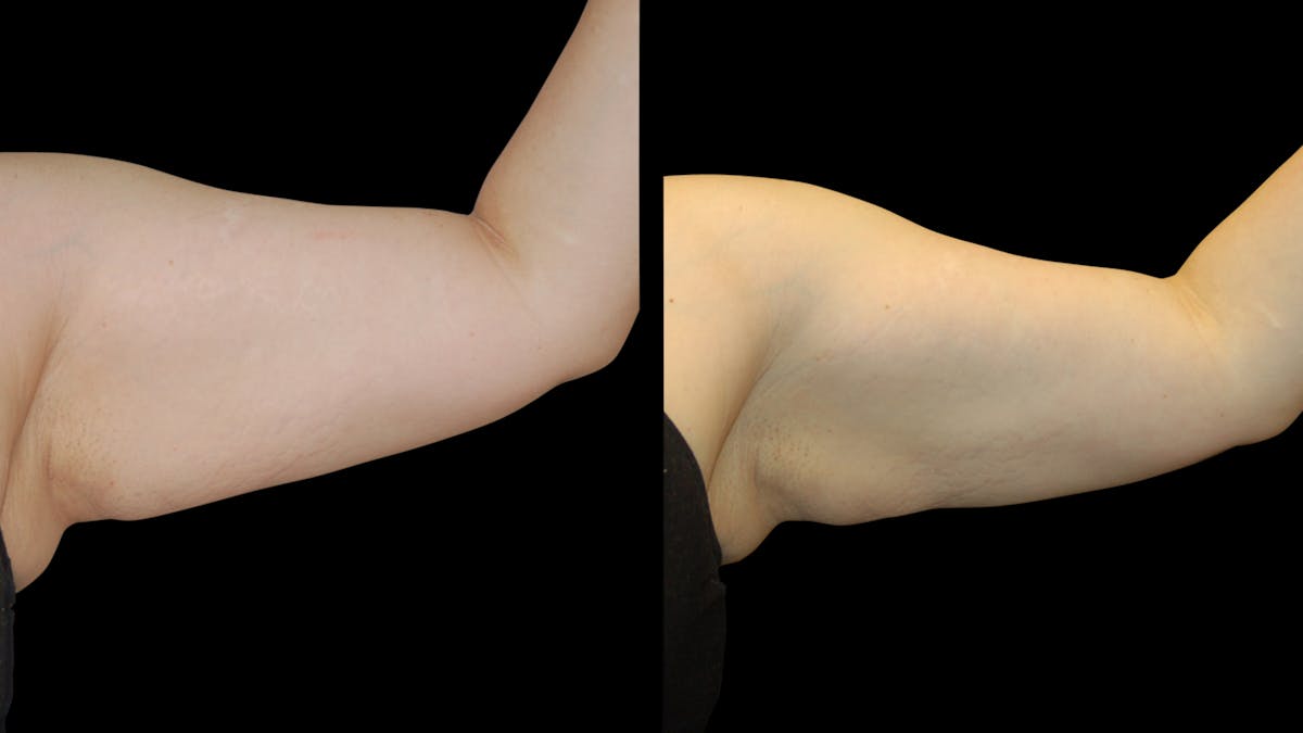 Liposuction Before & After Gallery - Patient 235574 - Image 8