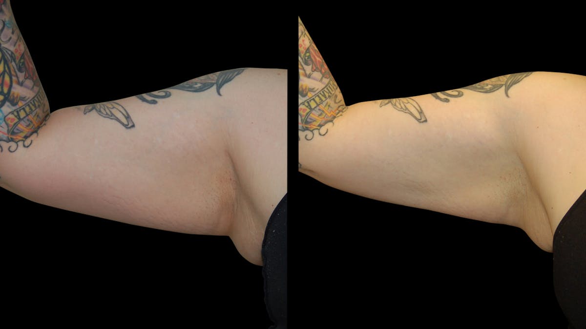 Liposuction Before & After Gallery - Patient 235574 - Image 9