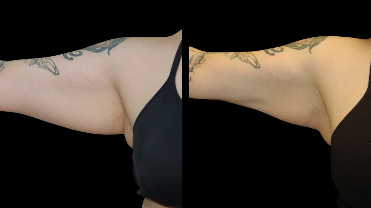 Liposuction Before & After Gallery - Patient 235574 - Image 10