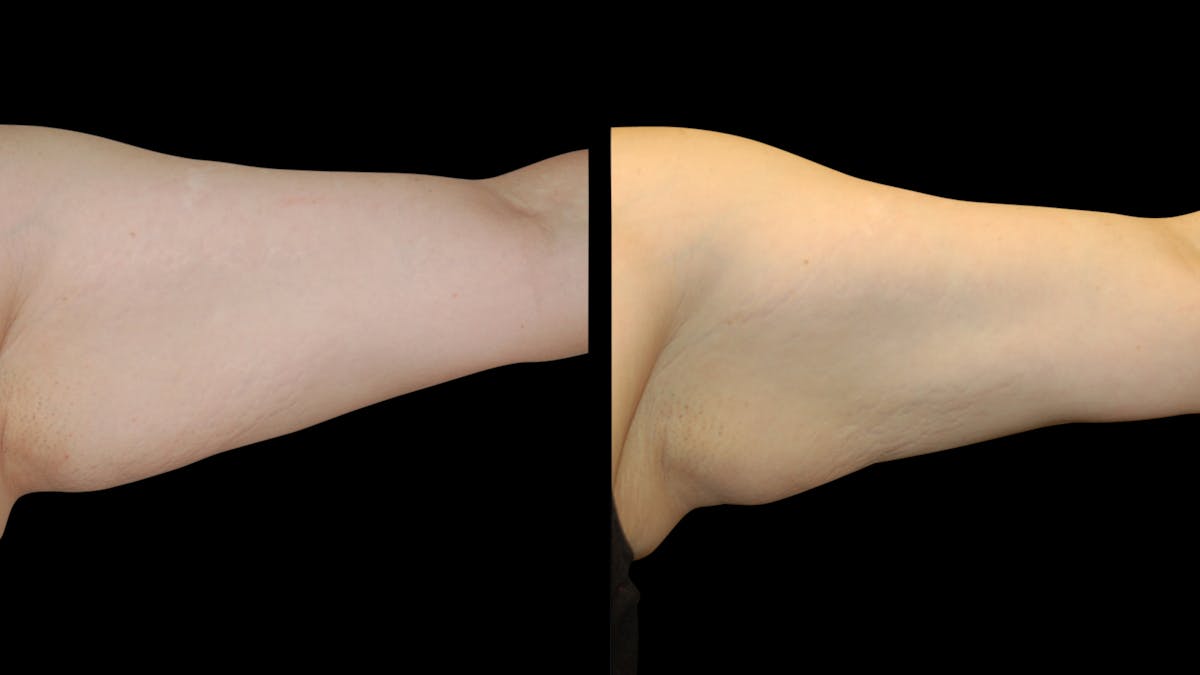 Liposuction Before & After Gallery - Patient 235574 - Image 11