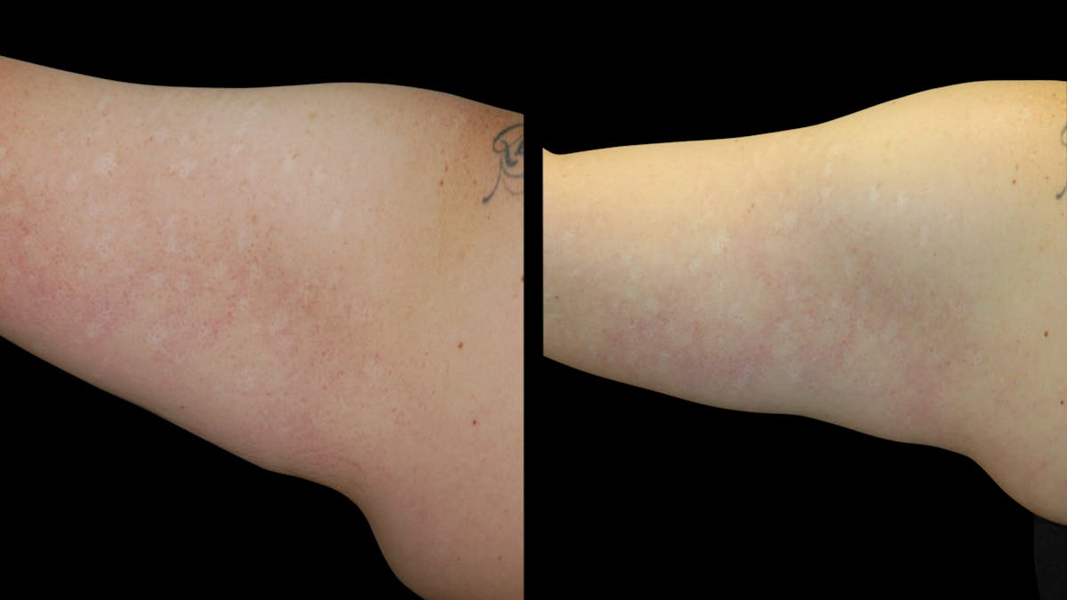 Liposuction Before & After Gallery - Patient 235574 - Image 12