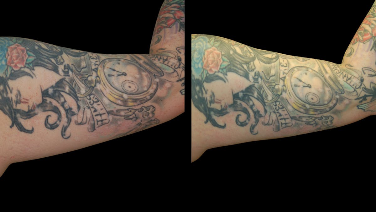 Liposuction Before & After Gallery - Patient 235574 - Image 13