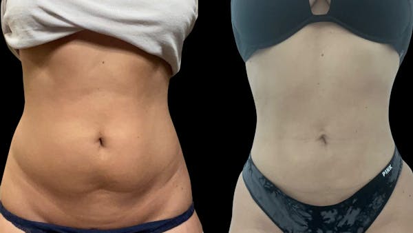 Liposuction Before & After Gallery - Patient 381027 - Image 1